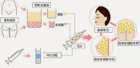 自体脂肪填充眼部凹陷有以下注意事项