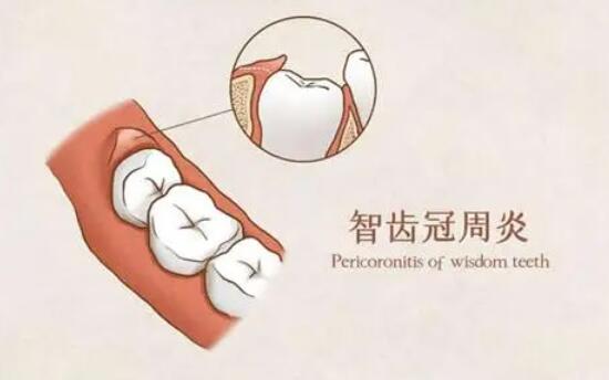 冠周炎拔牙多少钱?