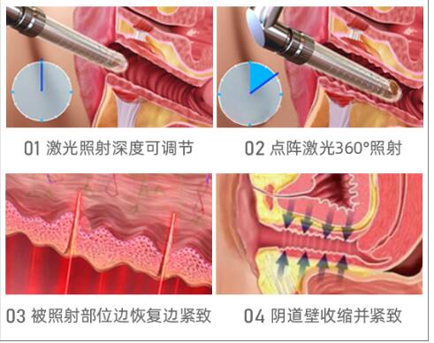 缩阴手术的方法有几种?