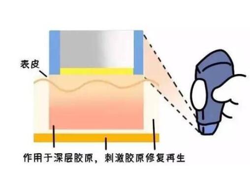 热玛吉要做几次才有效果呀?