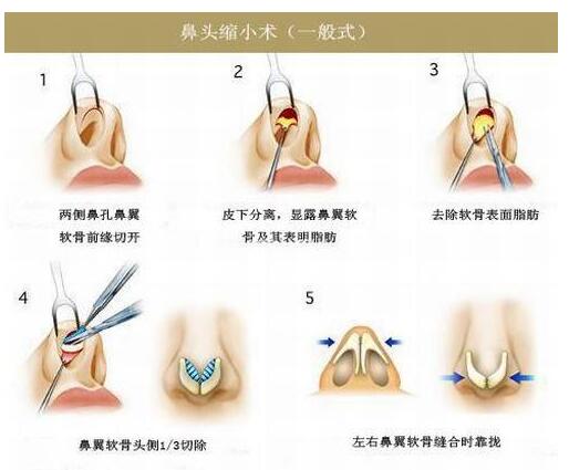 缩鼻头后注意事项