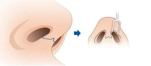 缩鼻头后注意事项