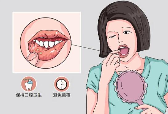 如何治疗口腔溃疡和预防口腔溃疡？提供4个参考方案