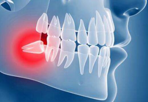 完智齿的注意事项