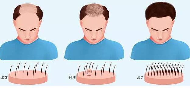 植发可以用别人的毛囊吗?