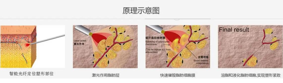 射频溶脂是永久的吗?