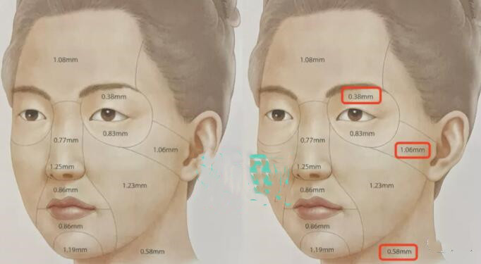 法令纹填充后应注意的事项