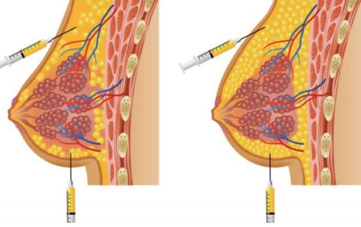 浙医二院胡学庆脂肪填充隆胸怎么样?