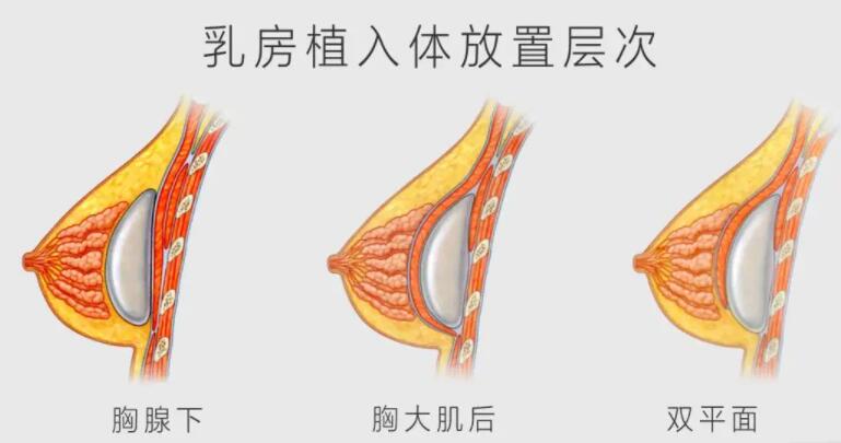 北京安贞医院整形外科李文志医生隆胸案例分享