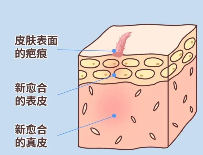 人体可以自行修复疤痕，时间长了就会没有对吗?