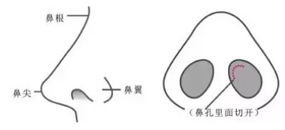 北京301医院整形科郭伶俐医生完成隆鼻的案例分享