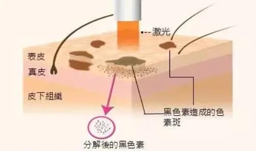 激光祛斑的副作用有哪些?