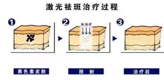 涂抹祛斑产品