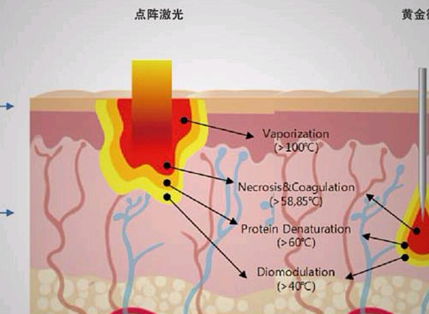 光子嫩肤具有哪些优点?