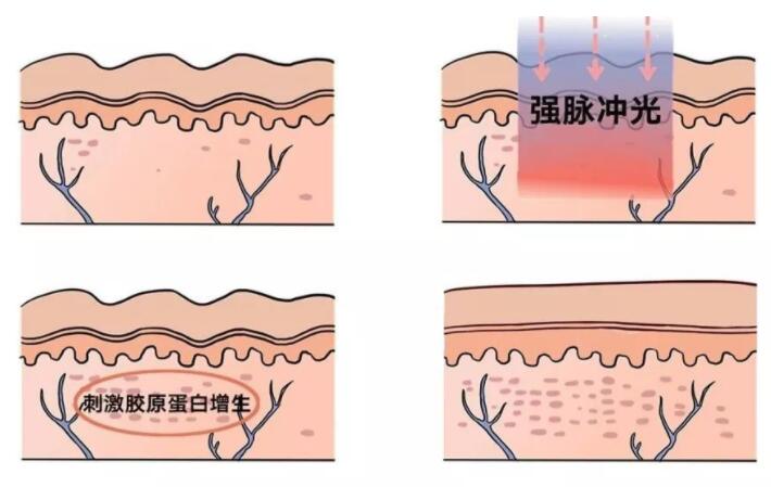 光子嫩肤有哪些注意事项?