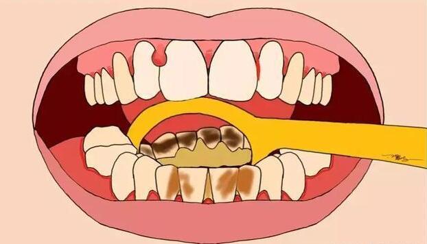 去除牙结石要多少钱一次？影响价格因素|如何预防？