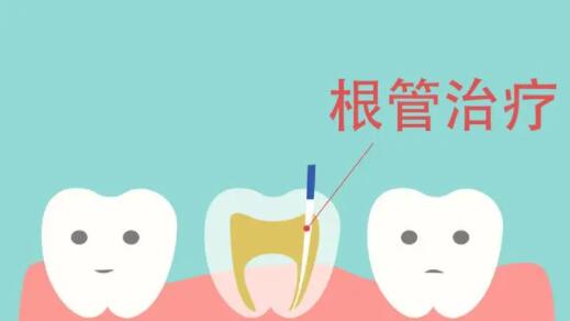 南方医院牙齿根管治疗多少钱一颗?