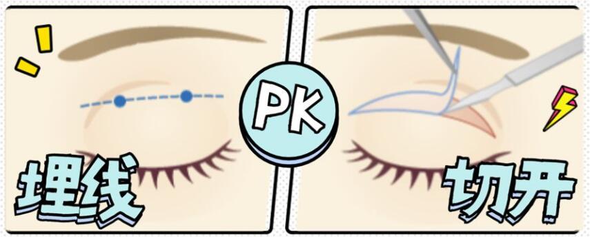 广州曙光整形医院双眼皮案例分享