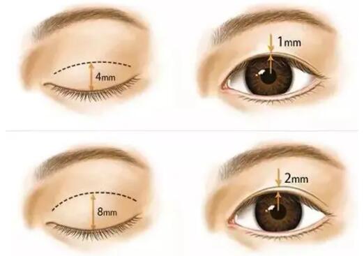 深圳希思医疗美容医院双眼皮案例