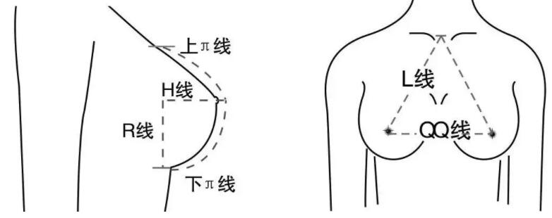 广州积美整形医院隆胸案例