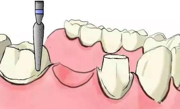 牙齿种植手术