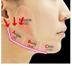 下颌角整形后注意事项
