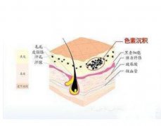 复合彩光除皱有用吗？复合光彩多少钱？