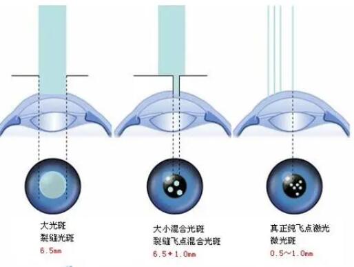 什么是准分子激光?