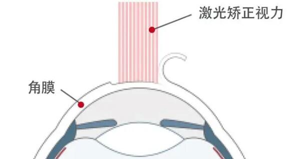 准分子激光之后注意事项有哪些?