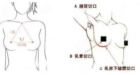 英国娜高假体多少钱?