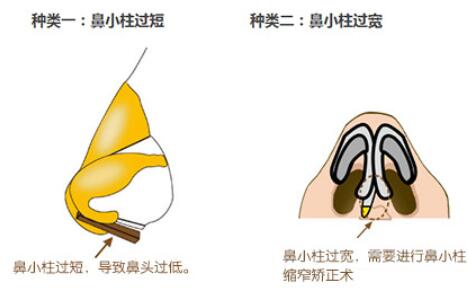 攀枝花市中心医院隆鼻案例分享