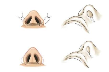 鼻翼缩小手术多少钱?