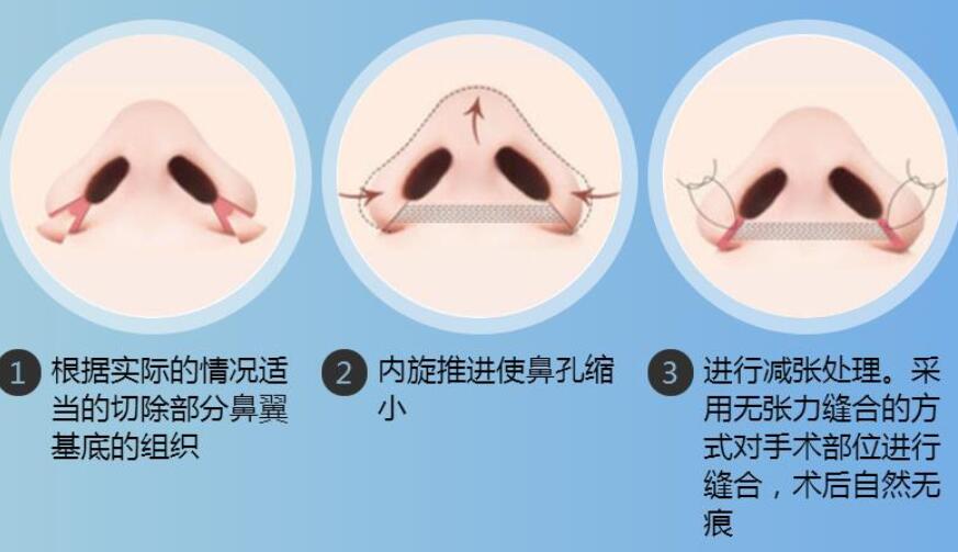 鼻翼缩小手术效果好吗?