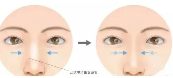 北医三院隆鼻案例分享