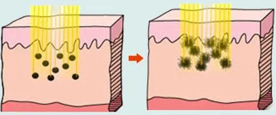 镭射净肤的原理是什么呢?