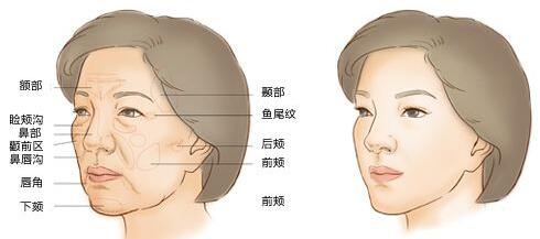 刘李娜全脸填充案例