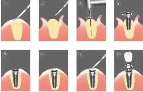 种植牙注意事项