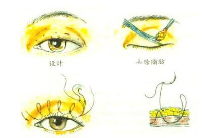 双眼皮手术的案例分享