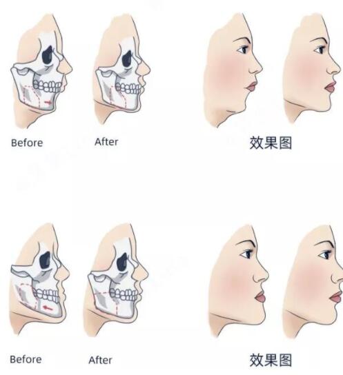 上海九院口腔科颌面整形案例