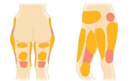 瘦腿吸脂术多少钱？技术原理、预期效果、护理注意事项