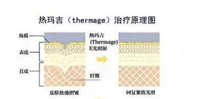 热玛吉五代做一次多少钱?