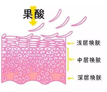 芯丝翠果酸换肤治疗方法