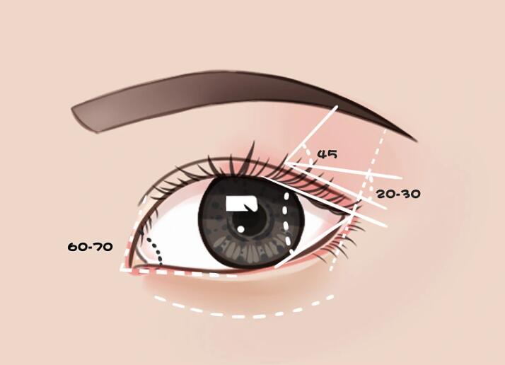 双眼皮手术有哪些方法?