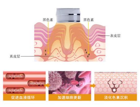 光子嫩肤去红血丝案例