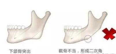 消骨瘦脸手术之后就注意哪些问题呢?