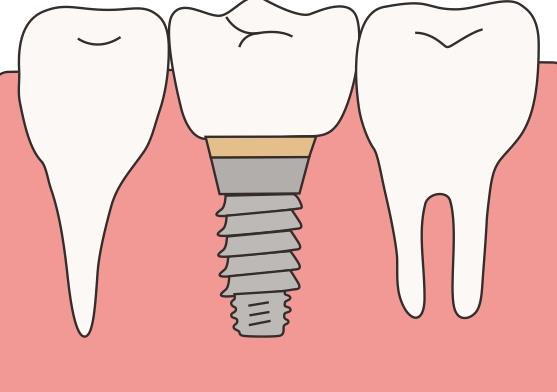 种植牙