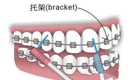 牙齿正畸