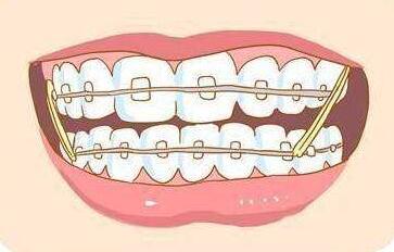 牙齿矫正