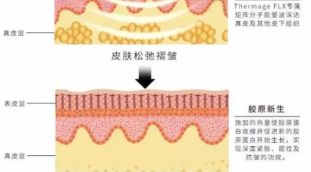 热玛吉