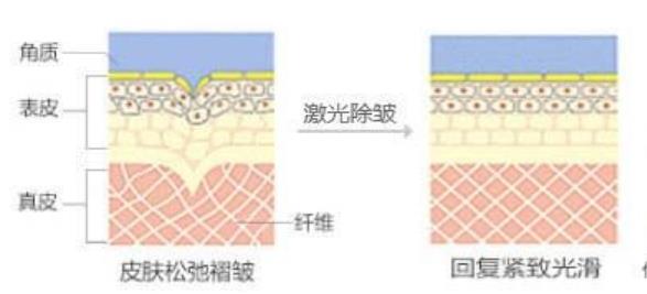 激光除皱